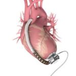 süni ürək – HeartWare