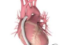 Azərbaycanda ilk dəfə xəstəyə süni ürək köçürülüb