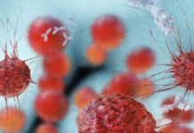 Ötən il dünyada 10 milyona yaxın insan xərçəngdən ölüb