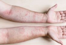 Son on gündə Cəlilabadda 83 nəfər qızılcaya yoluxub qızılca